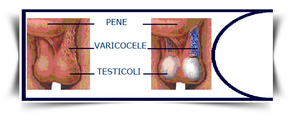 Varicocele Infertility Causes, Symptoms, Treatment & Surgery